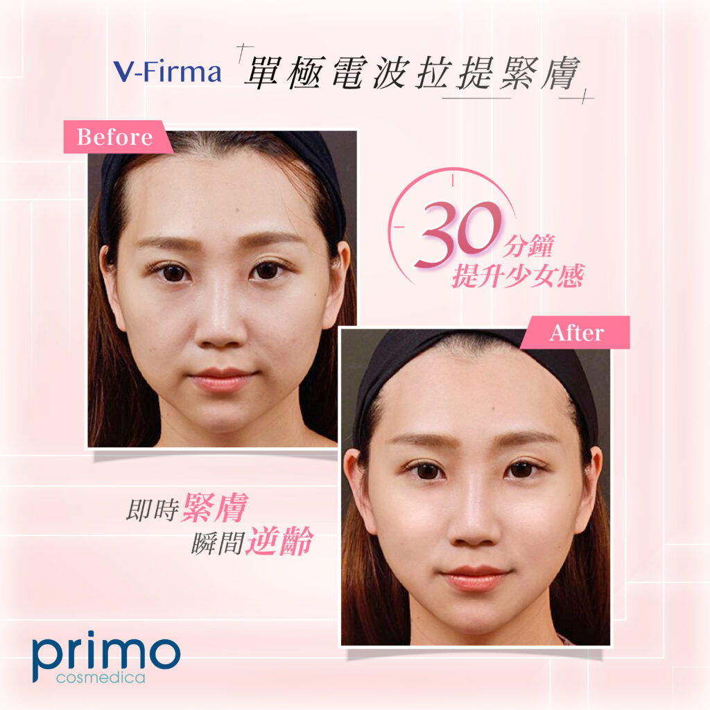 Before After
