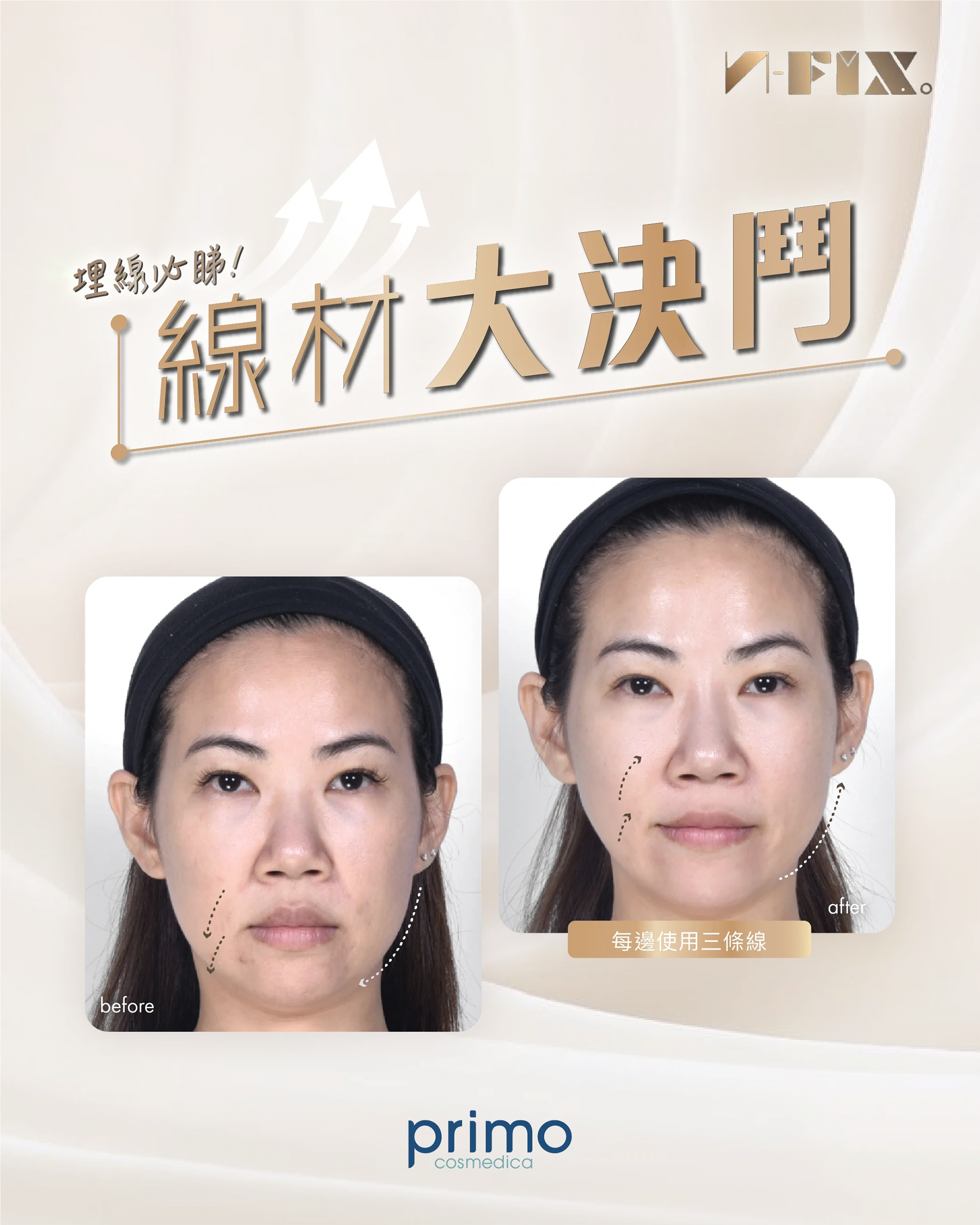面部埋線 真實效果 Before After