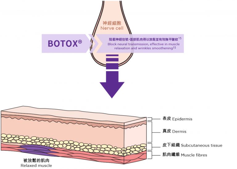 使用BOTOX® 保妥適後