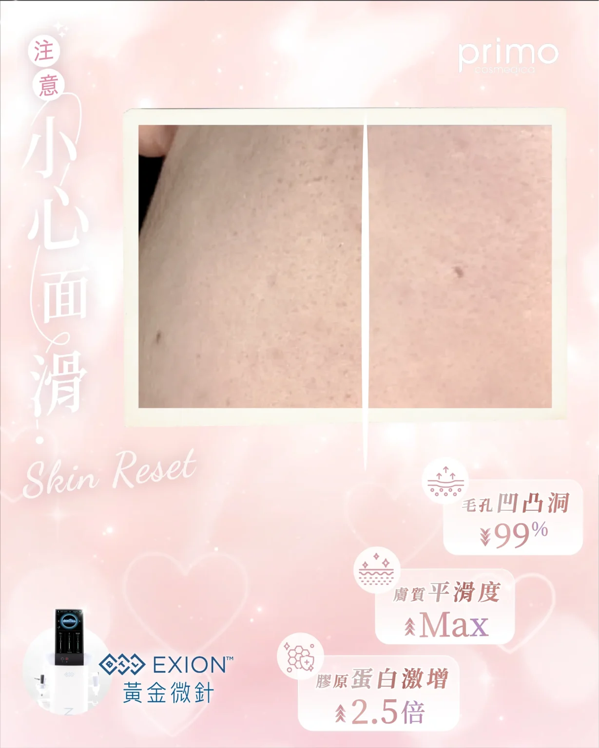 BTL EXION Before After