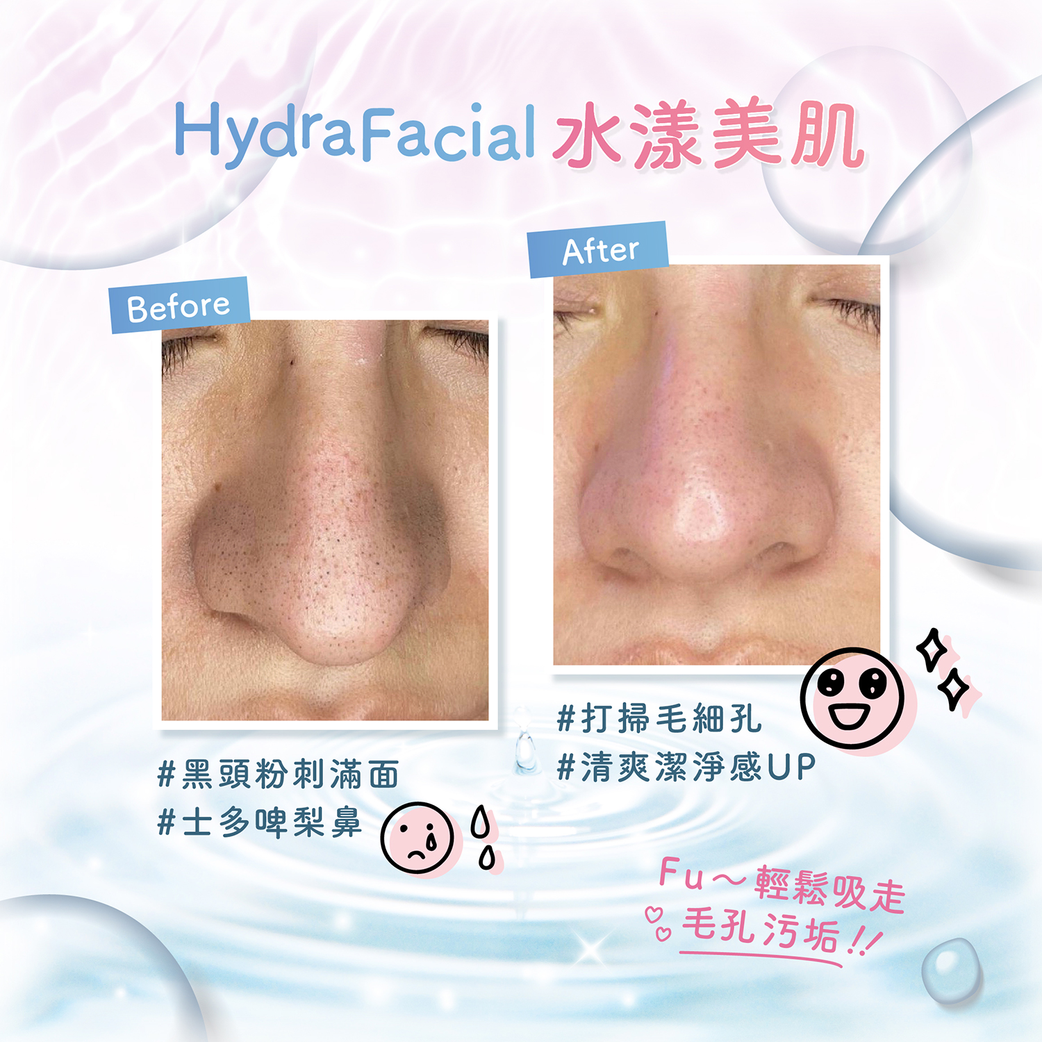 HydraFacial 醫學水漾美肌 真實效果 Before After