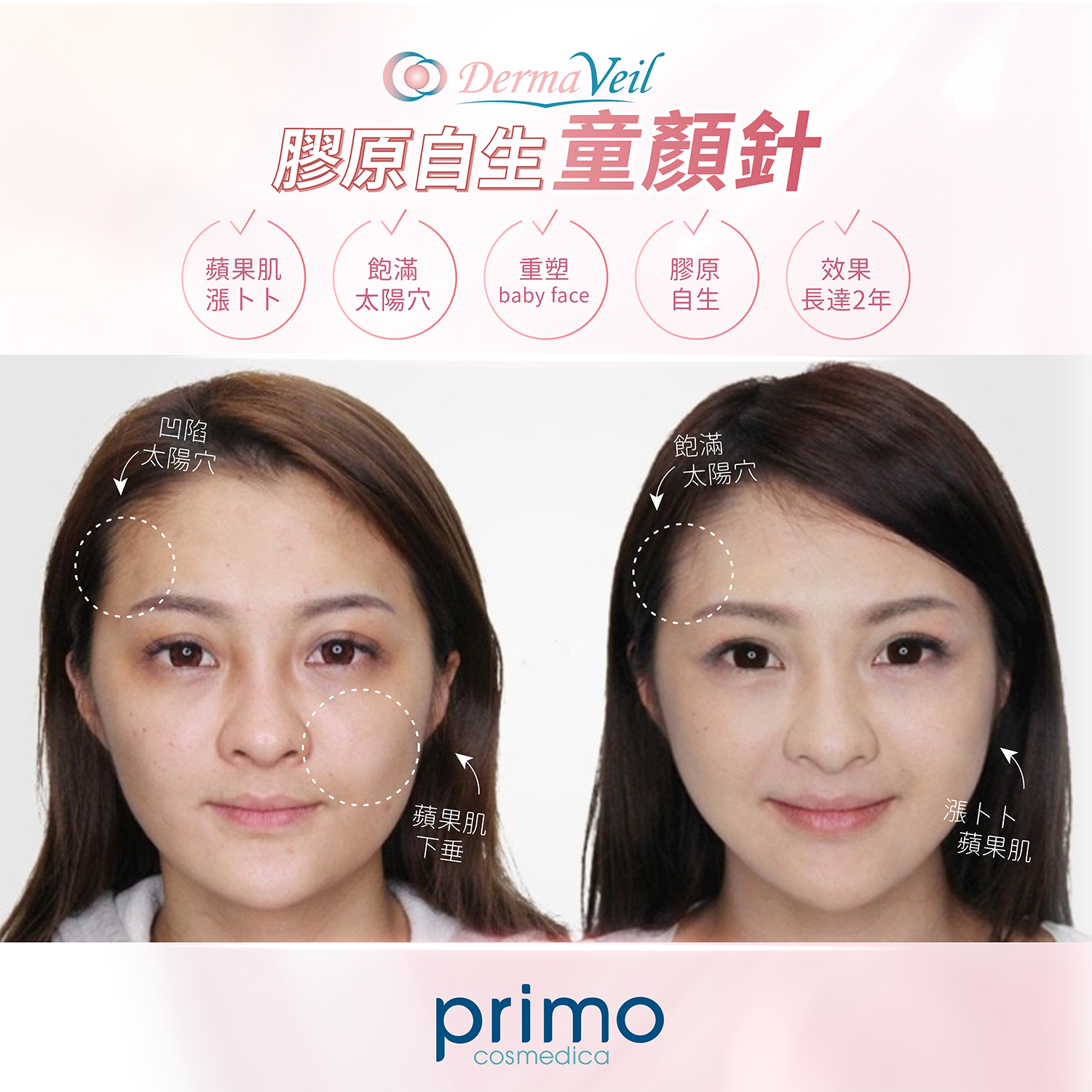 Derma Veil 真實效果 Before After