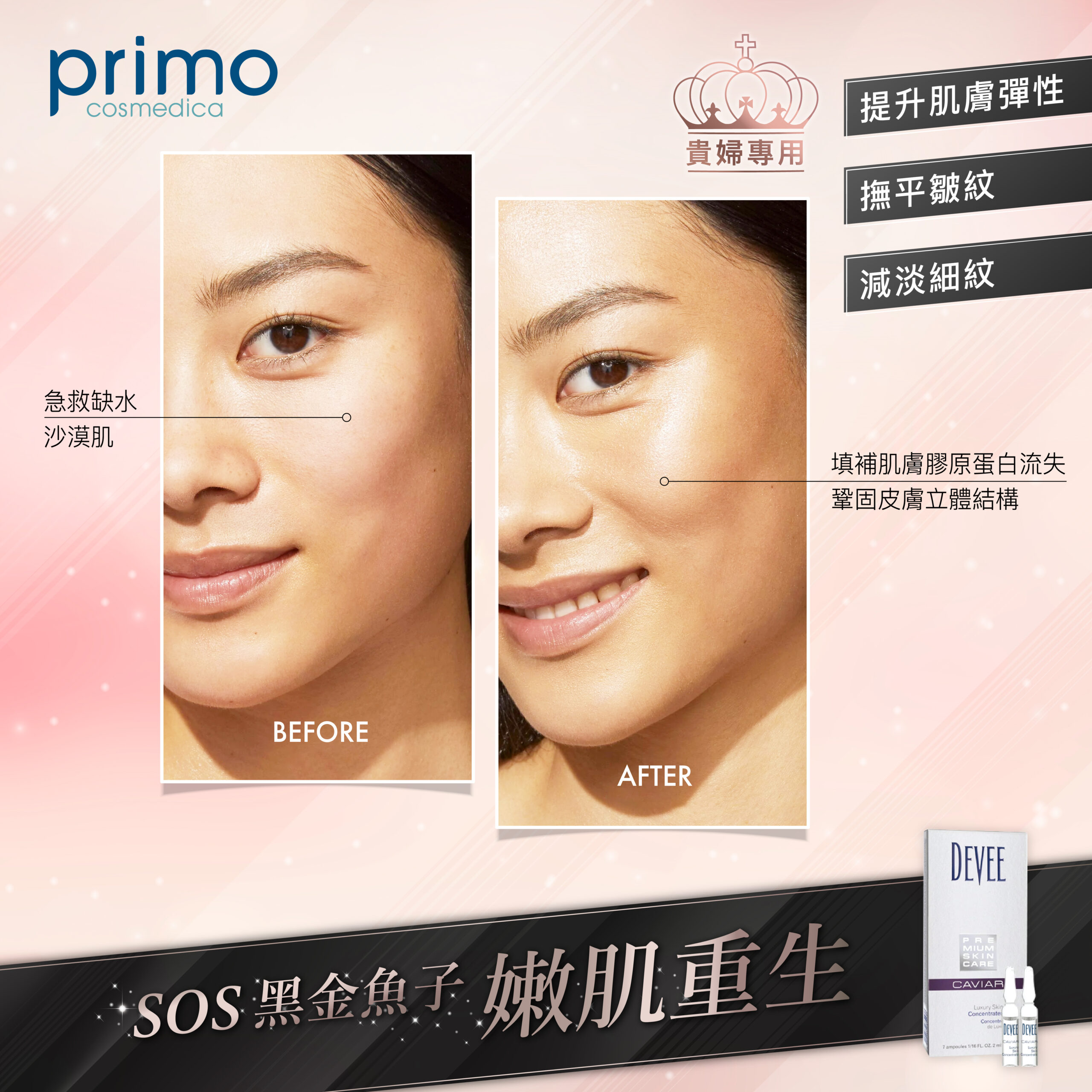 SOS黑金魚子嫩肌重生療程 真實效果 Before After