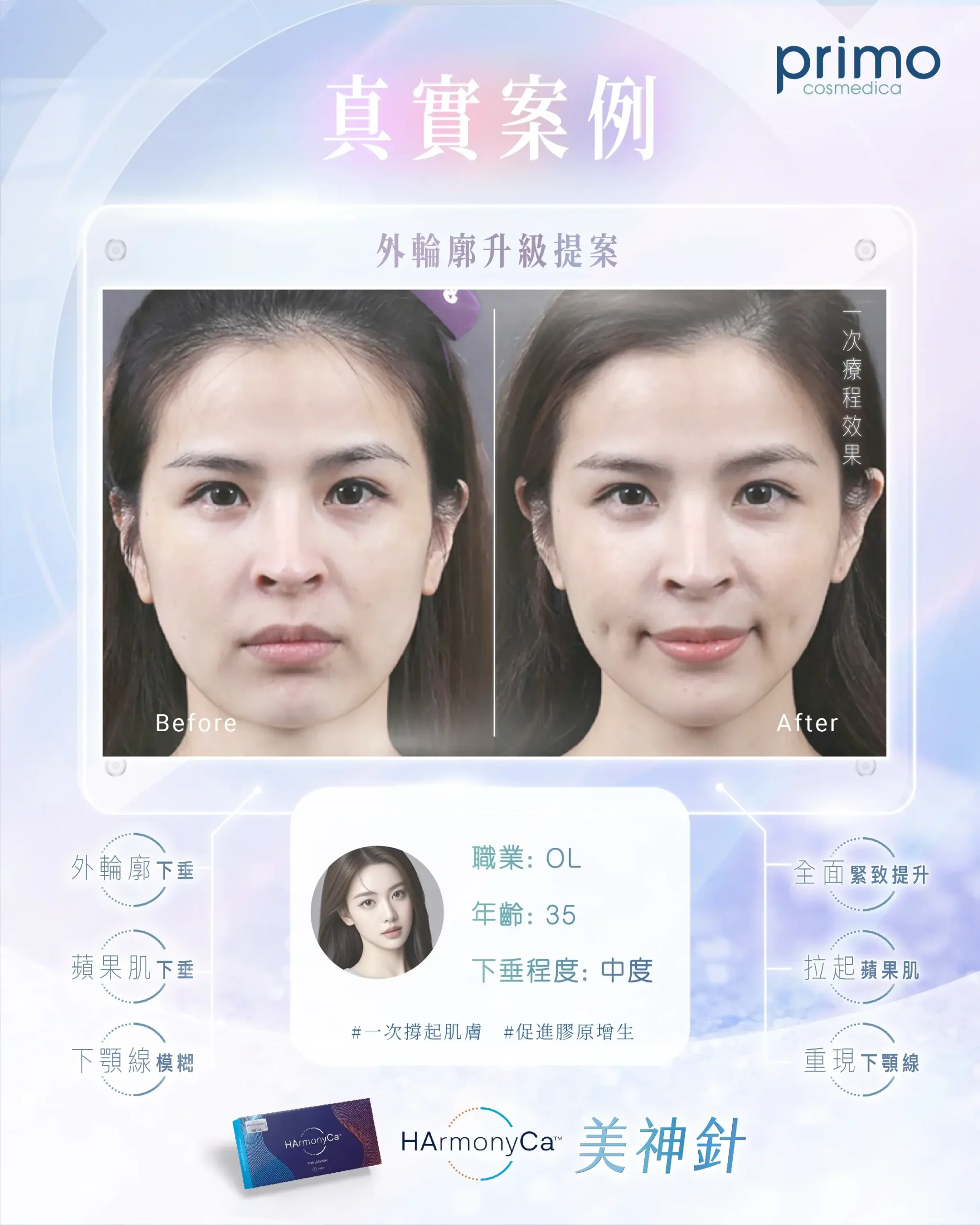 HarmonyCa™ 美神針真實療程效果