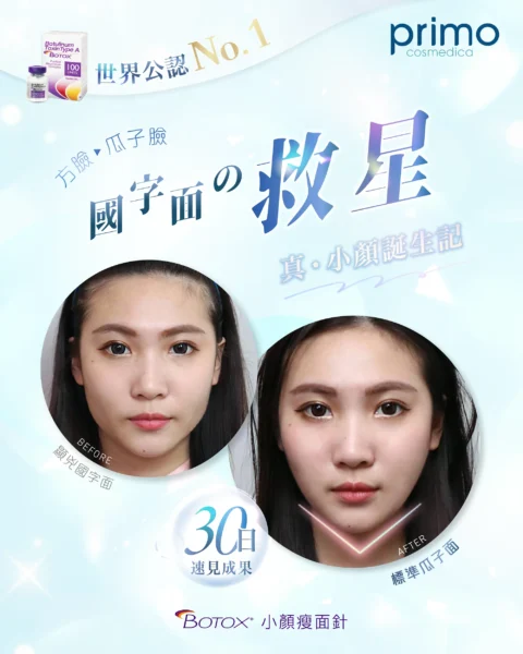 BOTOX® 瘦面針