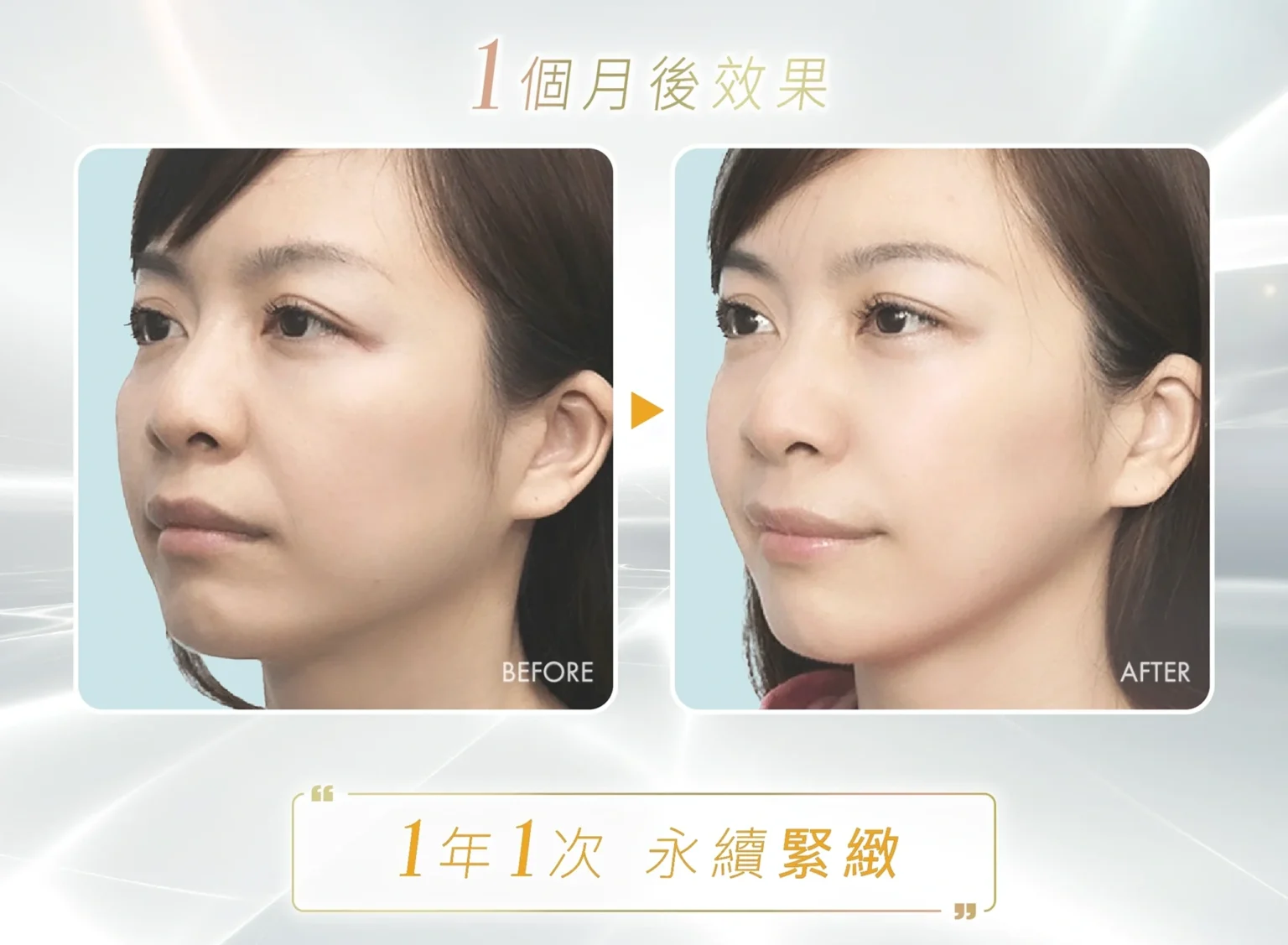 Ultherapy PRIME 效果 Before After